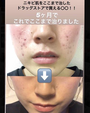 白色ワセリン 医薬品 健栄製薬の口コミ ニキビ肌をここまで治したドラッグストアで By Lさん 敏感肌 代後半 Lips