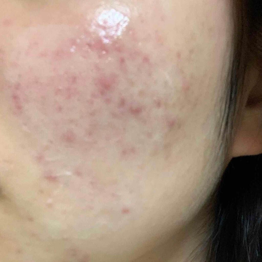 ニキビちゃん。 on LIPS 「誰か助けてください高校2年生です。皮膚科に通い薬も塗っているの..」(2枚目)