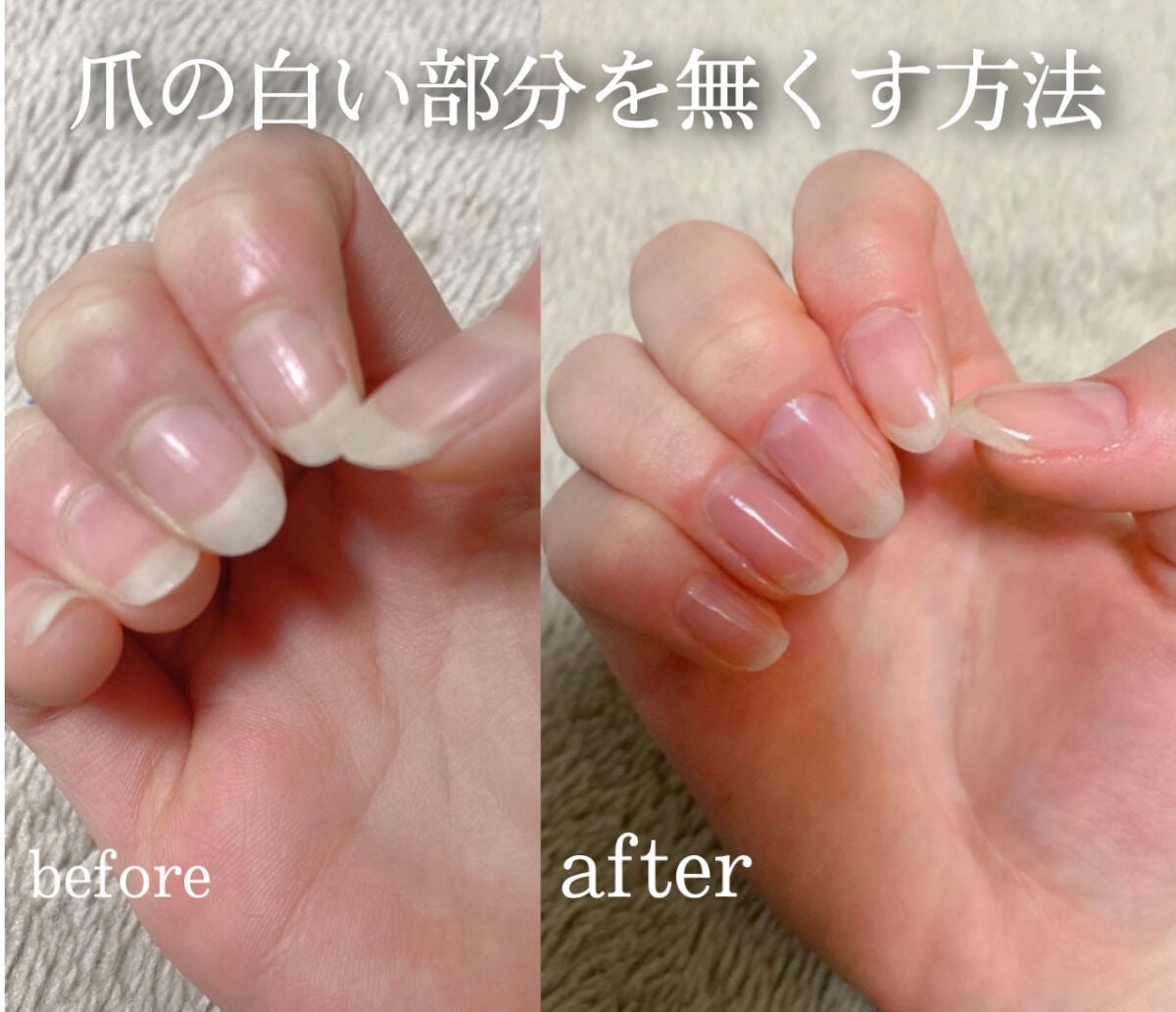 える on LIPS 「一ヶ月でハイポキニウム育成!ブサ爪だった私が一ヶ月頑張ったらこ..」(1枚目)