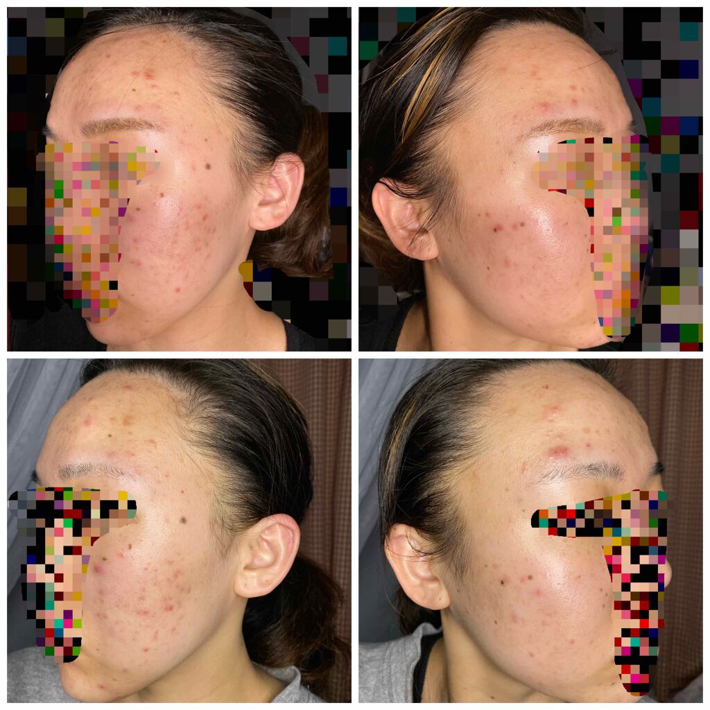 イベリコ豚 on LIPS 「ニキビになり早12年が経過しています。良くなるどころか悪くなる..」(2枚目)