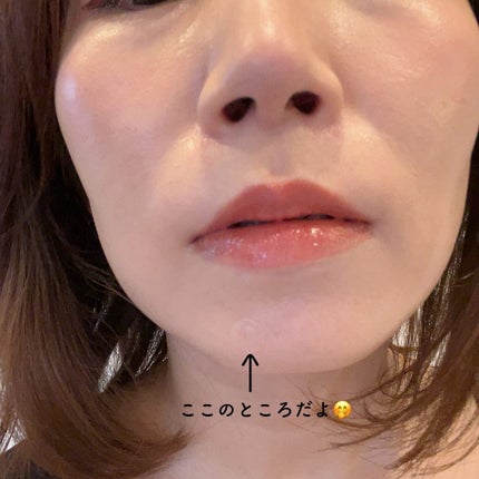 キャッチミーパッチ/CATCH ME PATCH/にきびパッチを使ったクチコミ(7枚目)