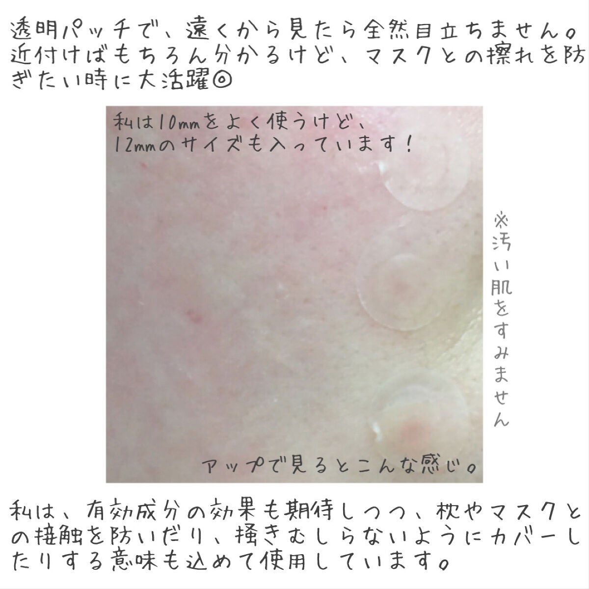 ゼロスポットパッチ/Today’s Cosme/にきびパッチを使ったクチコミ(2枚目)