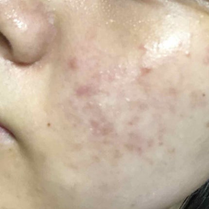 シカフルアンプル/beplain/美容液を使ったクチコミ(3枚目)