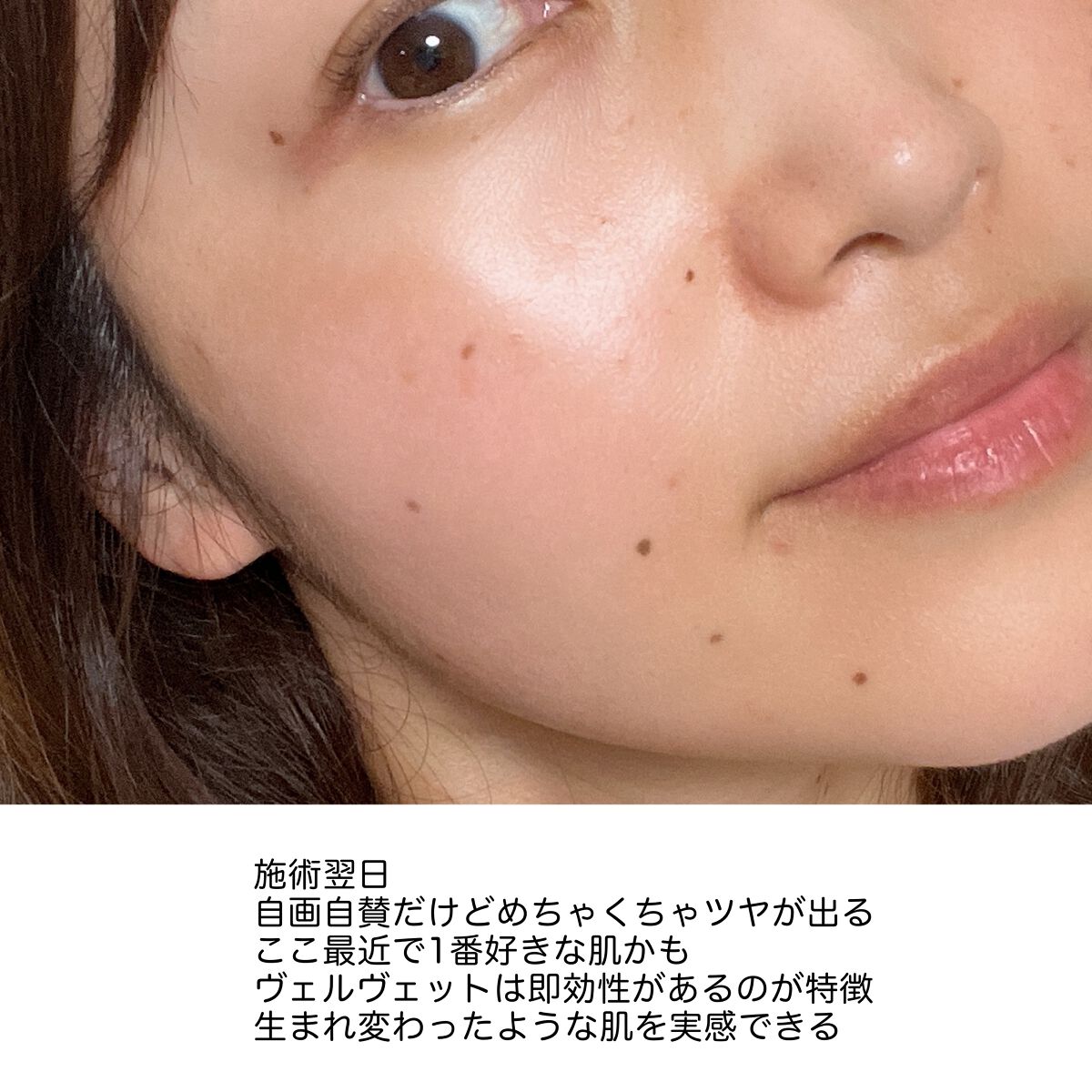 こはる on LIPS 「ダーマペン受けてきました/今月ははじめてのダーマペン受けること..」(4枚目)