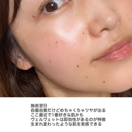 こはる on LIPS 「ダーマペン受けてきました/今月ははじめてのダーマペン受けること..」(4枚目)