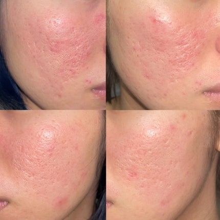 ダーマペン・ダーマスタンプ/MyM/その他スキンケアグッズを使ったクチコミ(2枚目)