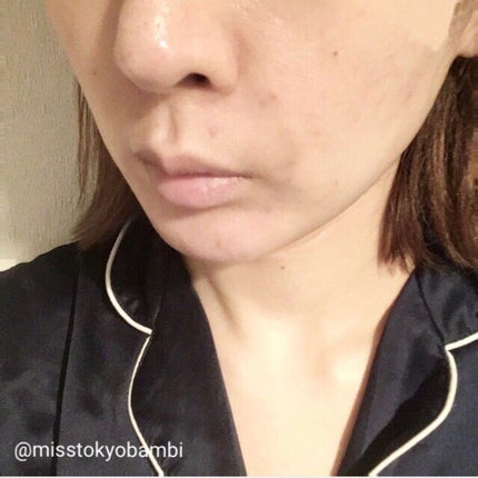 ヒアルロン酸注入/プラウドクリニック/その他を使ったクチコミ(6枚目)