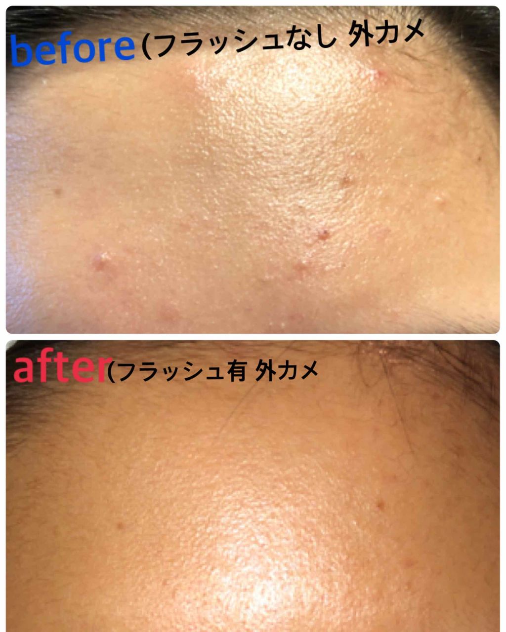 ビーソフテン ローション(医薬品)/持田製薬/その他を使ったクチコミ（2枚目）