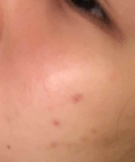 薬用 しみ 集中対策 美容液/メラノCC/美容液を使ったクチコミ(2枚目)