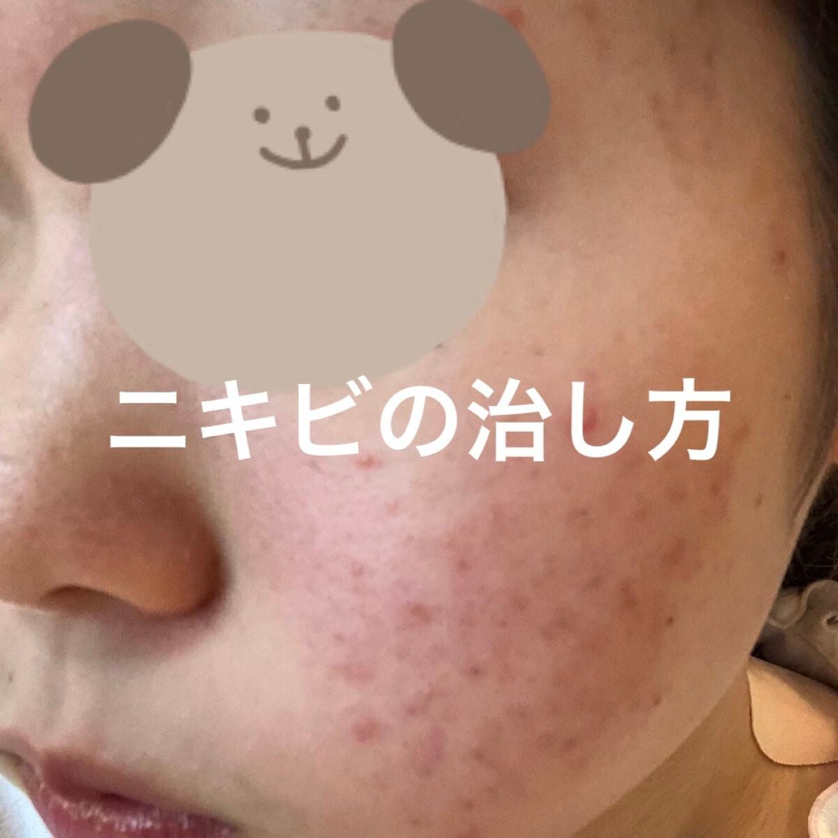 オードムーゲ 薬用ローション(ふきとり化粧水)/オードムーゲ/拭き取り化粧水を使ったクチコミ(1枚目)