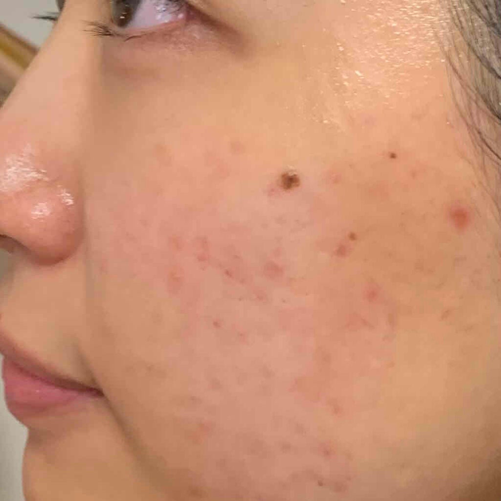 万年ニキビ肌 on LIPS 「9/25もう9月も終わりって早すぎ〜〜最近新しいニキビもほとん..」(1枚目)