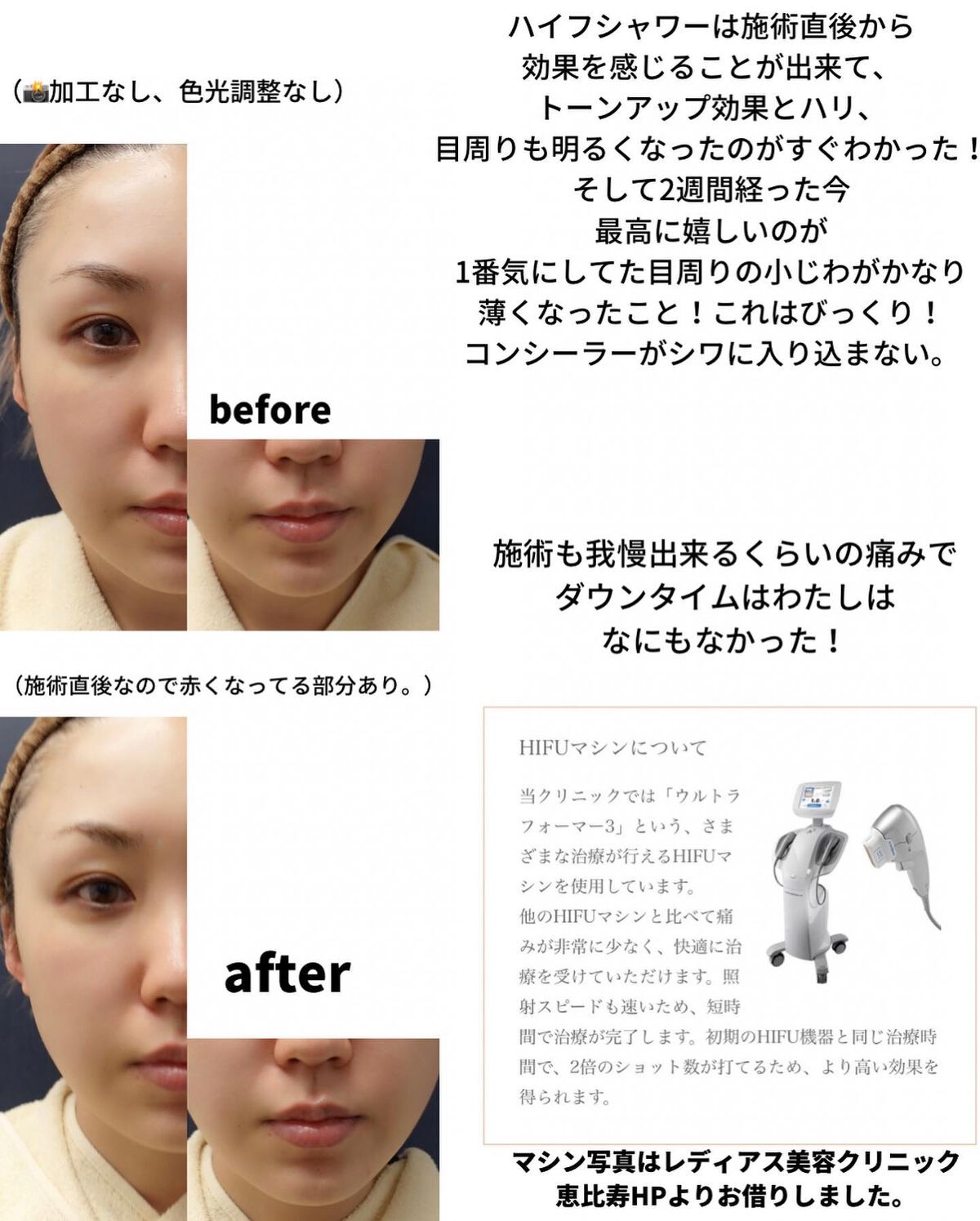 りっちゃん on LIPS 「ハイフシャワー受けてきました/実はハイフはやった事がなくて…..」(3枚目)