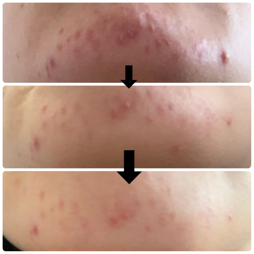 パーフェクショニスト プロ ブライト エッセンス アンピュール/ESTEE LAUDER/美容液を使ったクチコミ（2枚目）