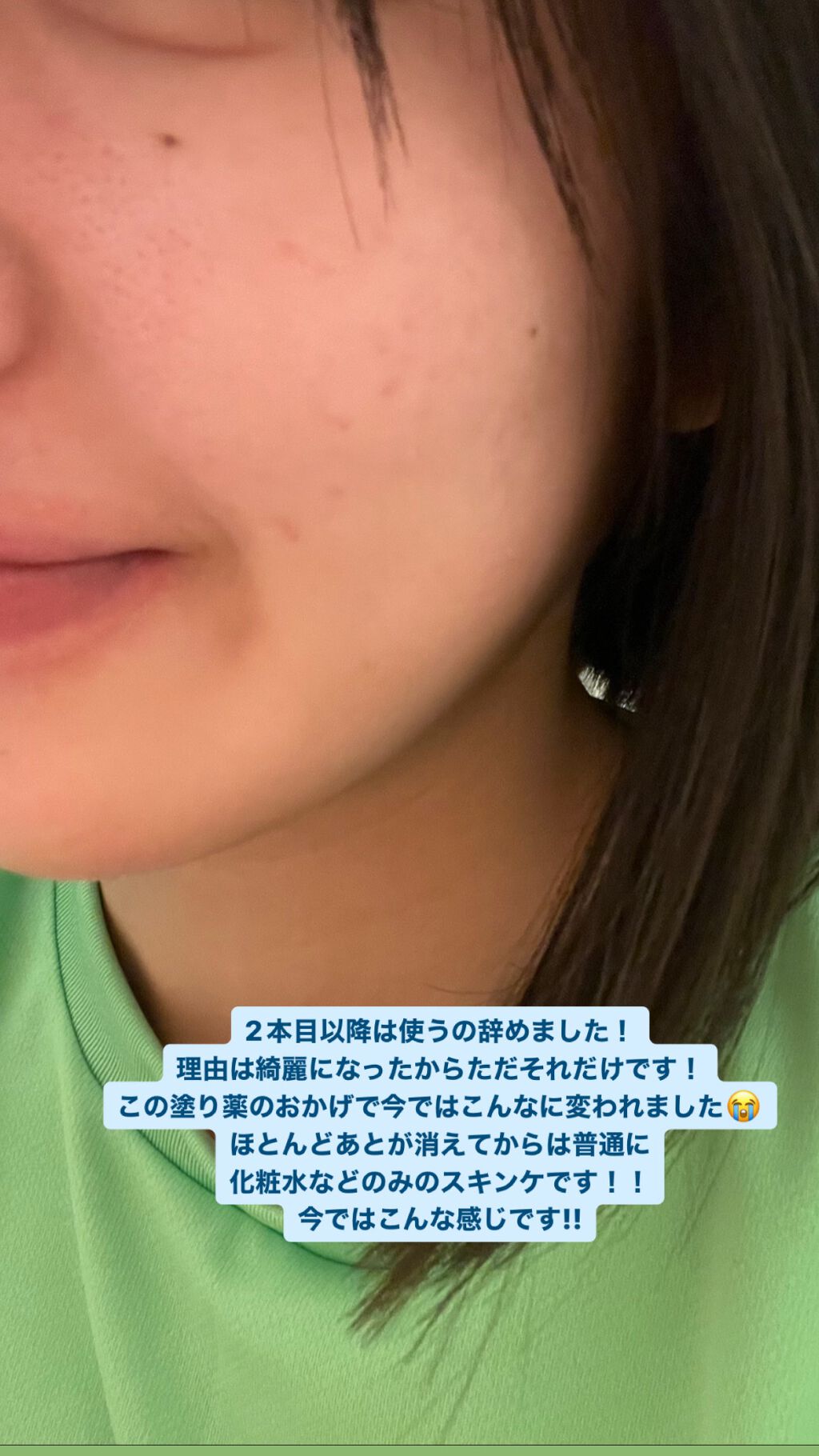 ニキビあとケアジェル/アットノン/その他スキンケアを使ったクチコミ(4枚目)