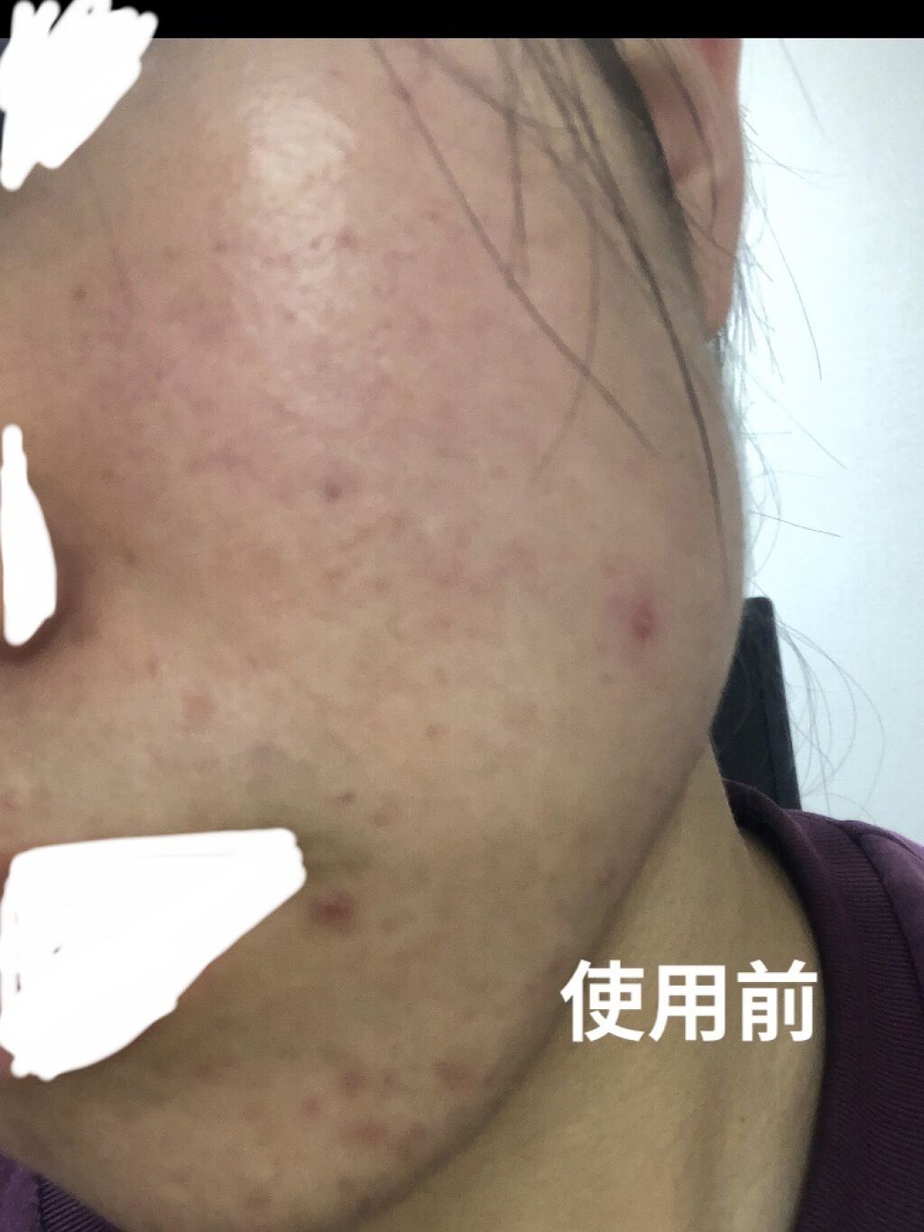 ベピオゲル/マルホ株式会社/その他を使ったクチコミ（2枚目）