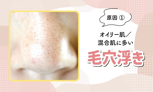 原因①オイリー肌・混合肌に多い毛穴浮き