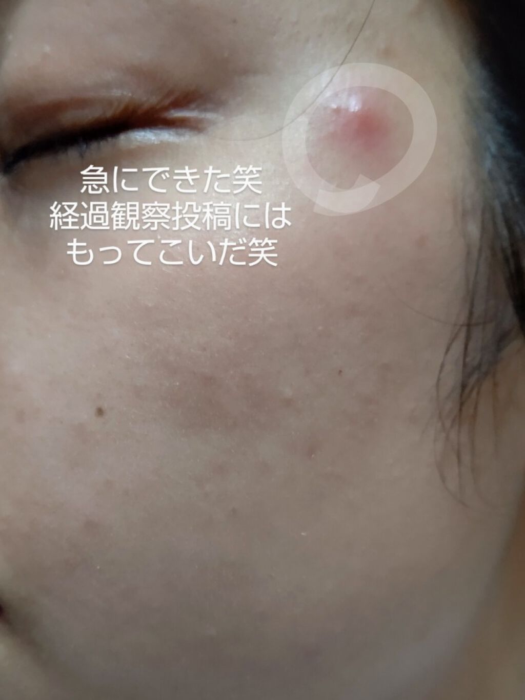 オードムーゲ 薬用ローション(ふきとり化粧水)/オードムーゲ/拭き取り化粧水を使ったクチコミ(3枚目)