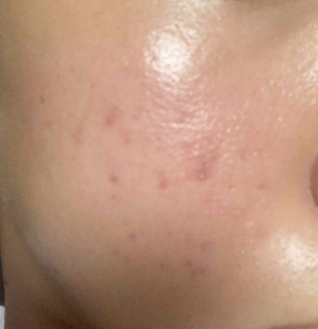 薬用 しみ 集中対策 美容液/メラノCC/美容液を使ったクチコミ（1枚目）