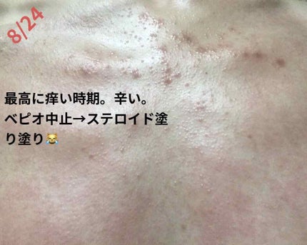 オロナインH軟膏 (医薬品)/オロナイン/その他を使ったクチコミ(3枚目)