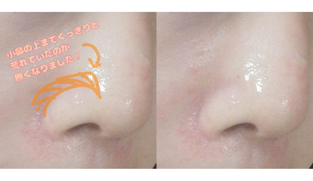 ピコモンテCAジェル/ドン・キホーテ/その他スキンケアを使ったクチコミ（3枚目）