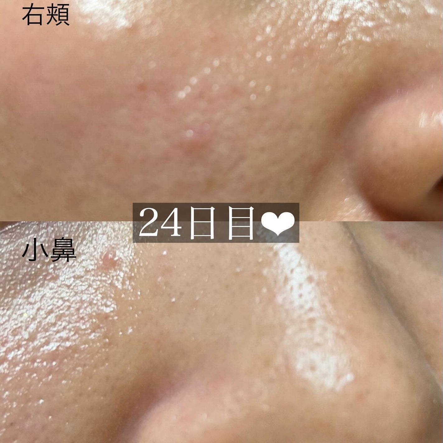 mii_美容・コスメ❤︎ on LIPS 「レチノール貯金24日目❤︎/ついに今日で毎日レチノールチ..」(7枚目)