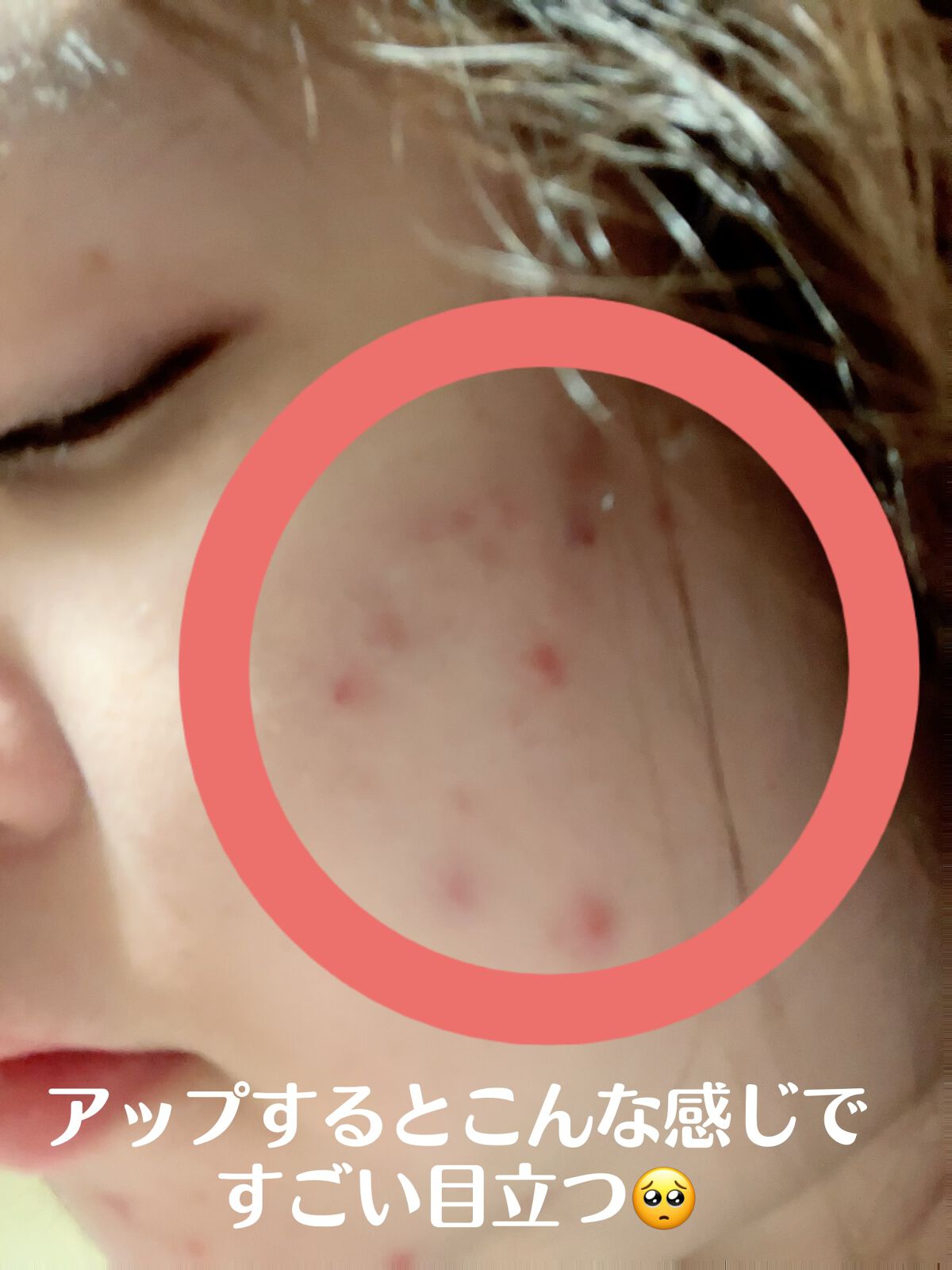 ましろ@風呂キャンQueen on LIPS 「おはようございます☺️※顔の画像ありますー。肌荒れの話なんであ..」(4枚目)