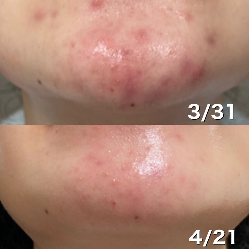 極潤 薬用ハリ化粧水【医薬部外品】/肌ラボ/化粧水を使ったクチコミ（2枚目）