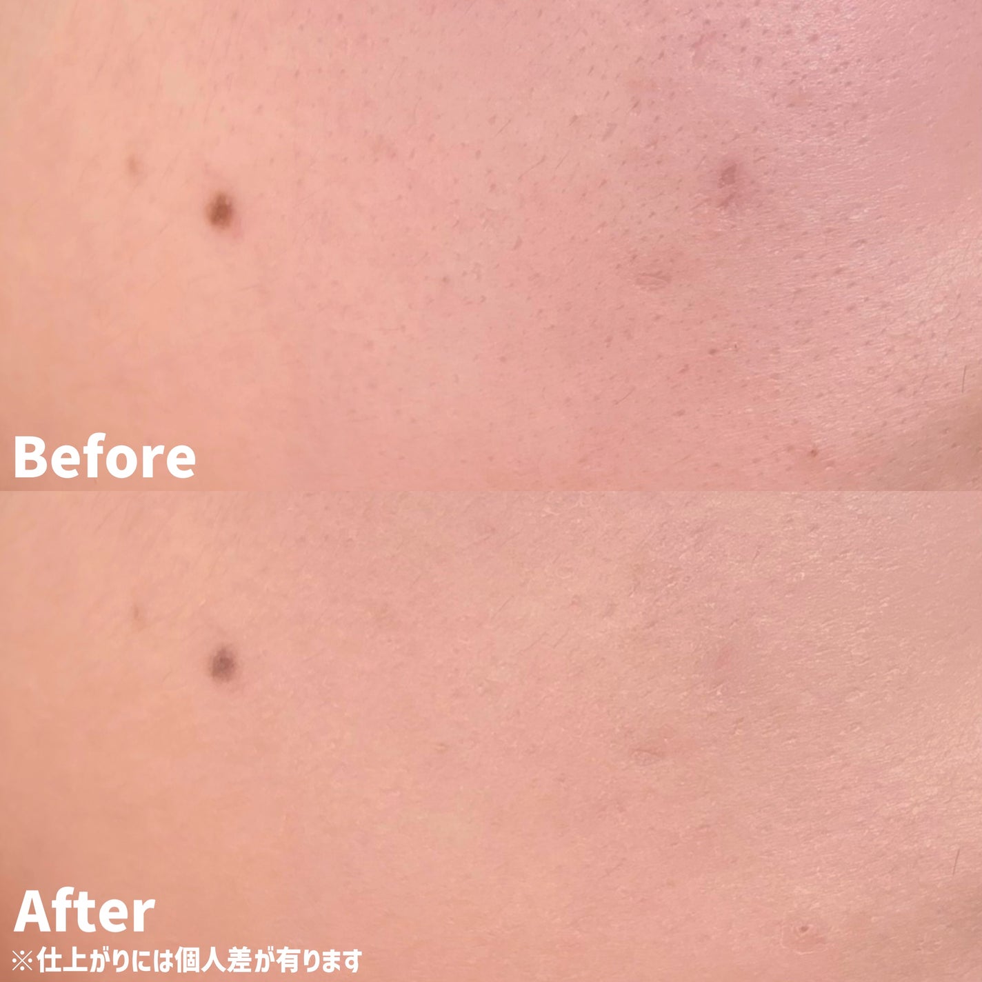 ダーマシンコンシーラー/23years old/リキッドコンシーラーを使ったクチコミ(4枚目)