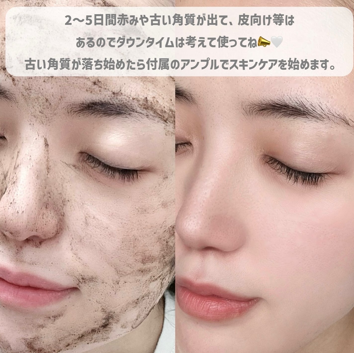 ダーマスキンピーリング/BQCELL/その他キットセットを使ったクチコミ(4枚目)