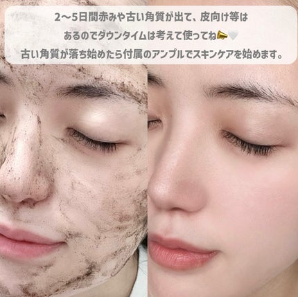 ダーマスキンピーリング/BQCELL/その他キットセットを使ったクチコミ(4枚目)