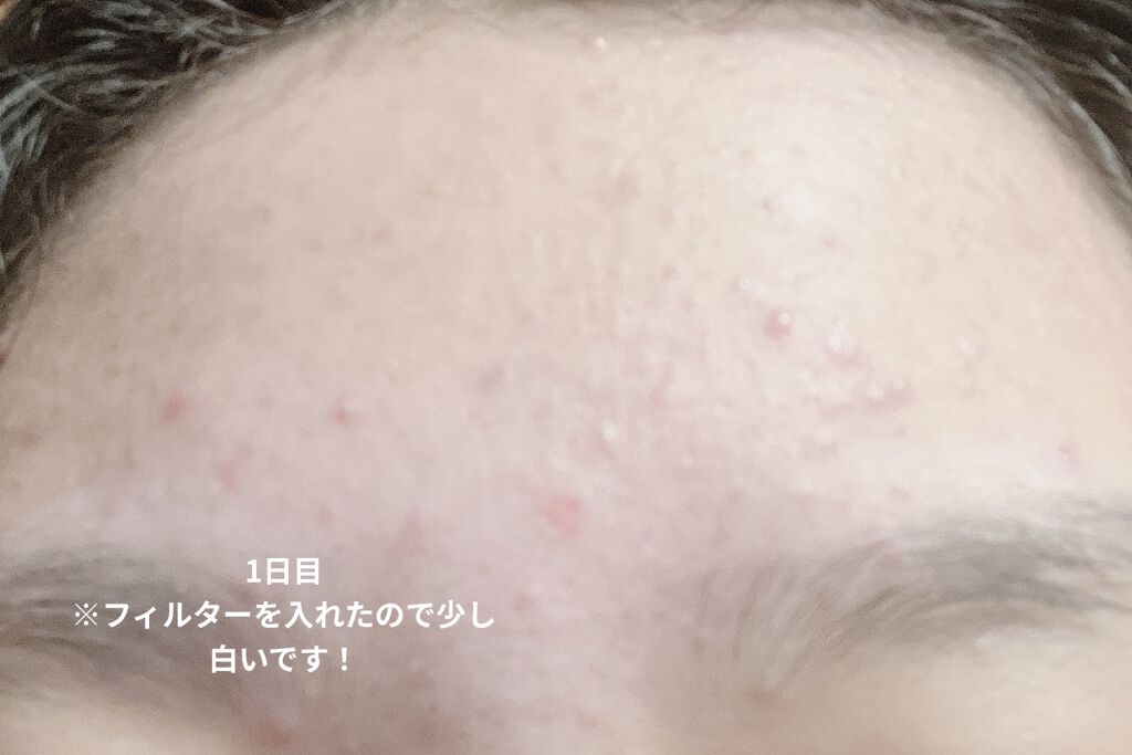 ロゼット洗顔パスタ アクネクリア/ロゼット/洗顔フォームを使ったクチコミ（2枚目）