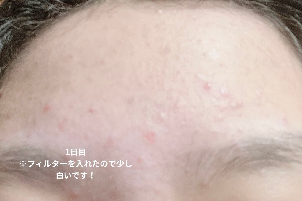 ロゼット洗顔パスタ アクネクリア/ロゼット/洗顔フォームを使ったクチコミ(2枚目)