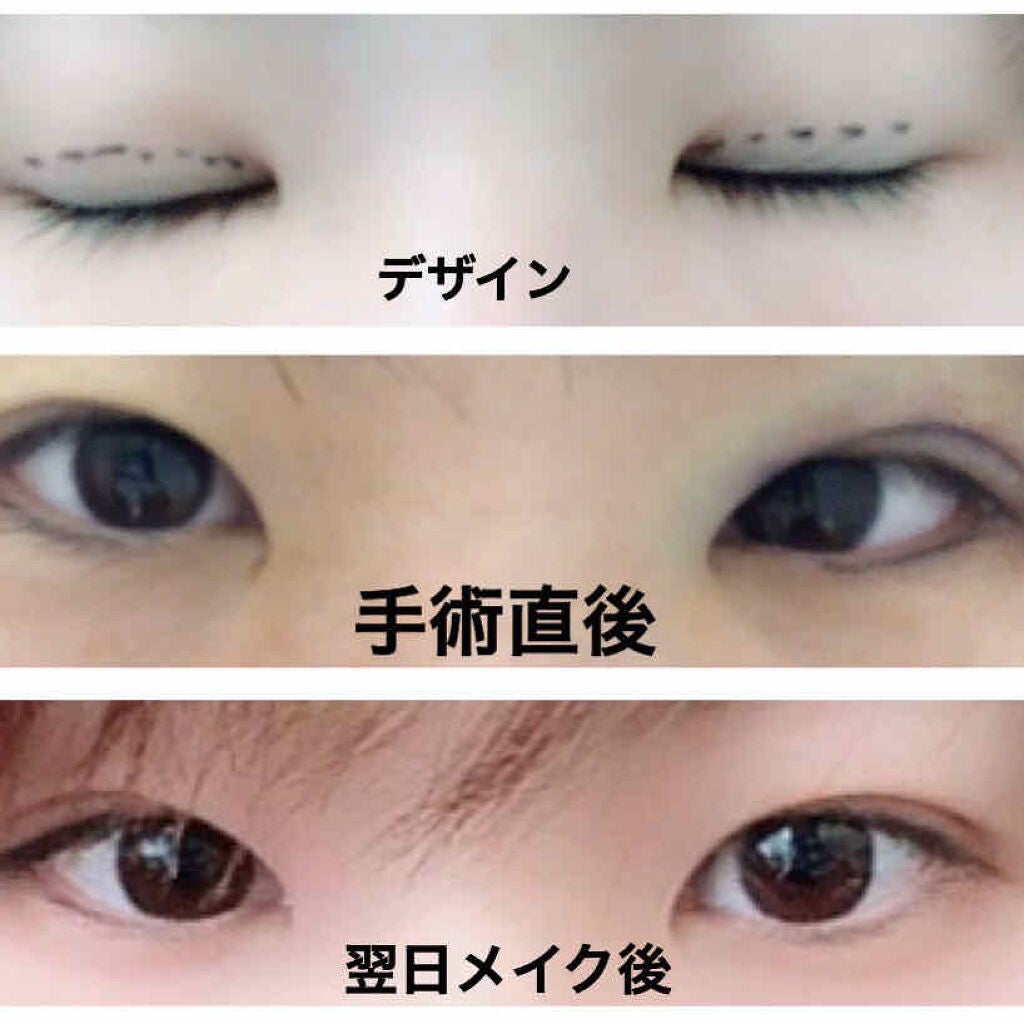 mikoto on LIPS 「二重整形(埋没方法)してきました。私は湘南美容外科でクイックコ..」(2枚目)