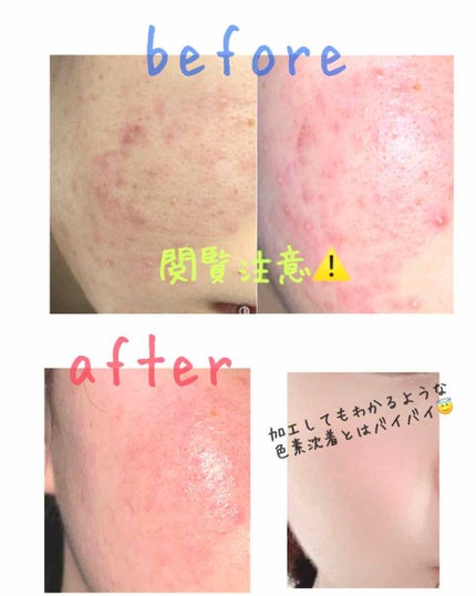 ホワイトケア トライアルセット/b.glen/スキンケアキットを使ったクチコミ(2枚目)