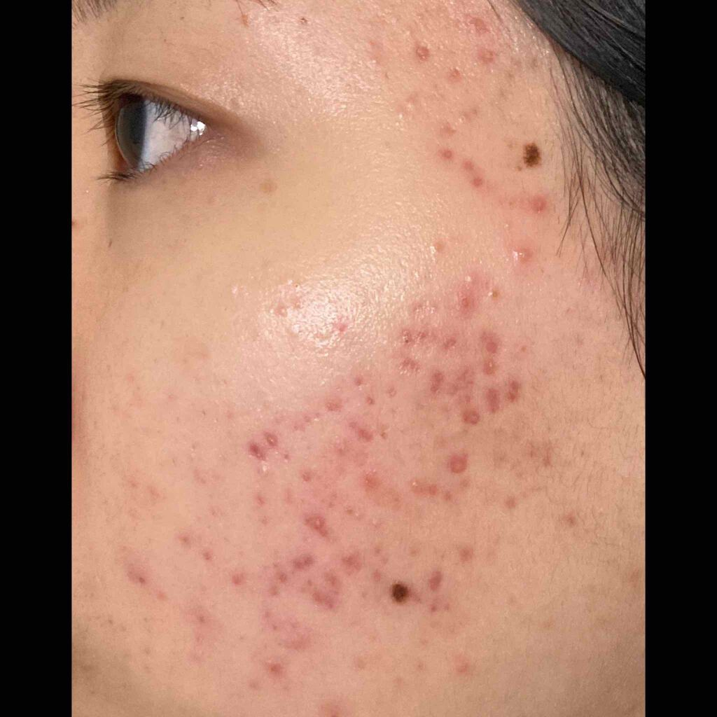 ハトムギ化粧水(ナチュリエ スキンコンディショナー R )/ナチュリエ/化粧水を使ったクチコミ(1枚目)