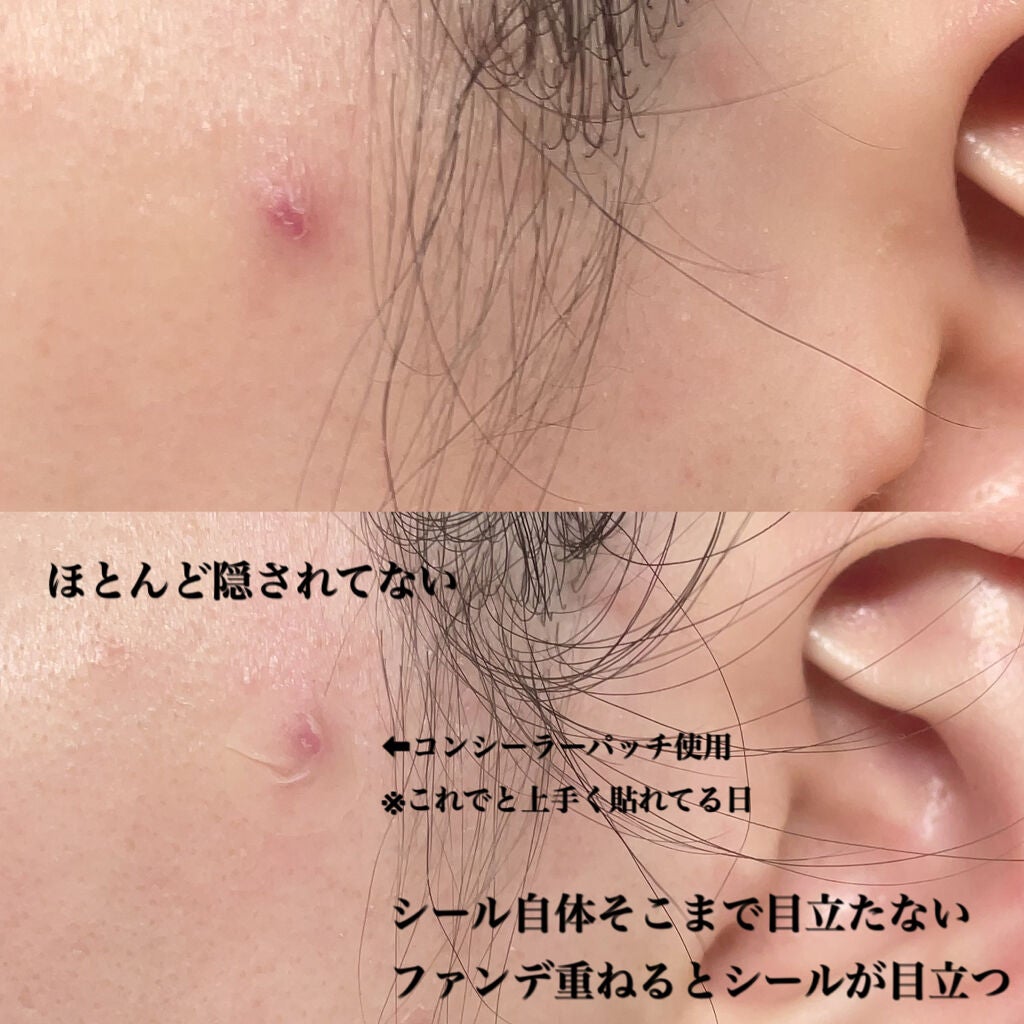 はるファンデ コンシーラーパッチ/大阪ソーダ/コンシーラーを使ったクチコミ(3枚目)