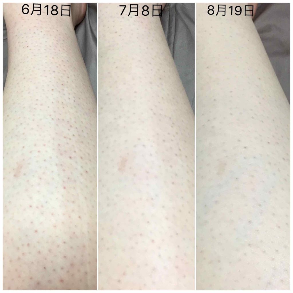 ケアノキュア（医薬品）/小林製薬/その他を使ったクチコミ（3枚目）