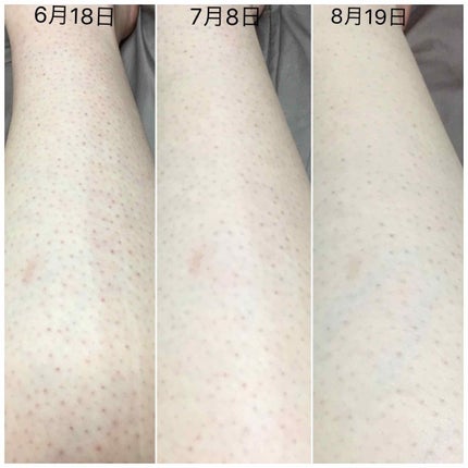ケアノキュア(医薬品)/小林製薬/その他を使ったクチコミ(3枚目)