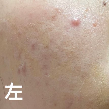 キツネ on LIPS 「生理5日目爆食いの結果またポツポツもニキビ達が🥲🥲🥲1歩進んで..」(1枚目)