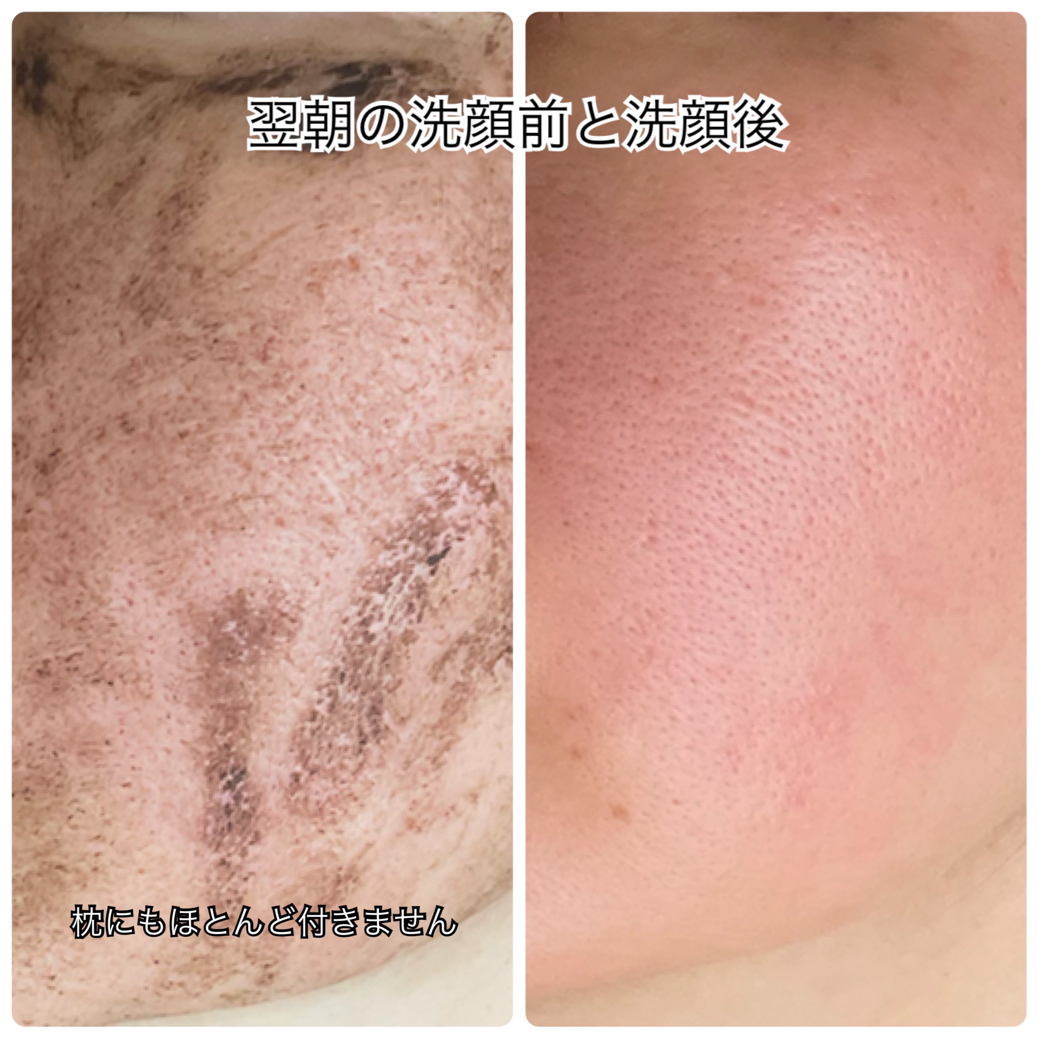 ダーマスキンピーリング/BQCELL/その他キットセットを使ったクチコミ（3枚目）