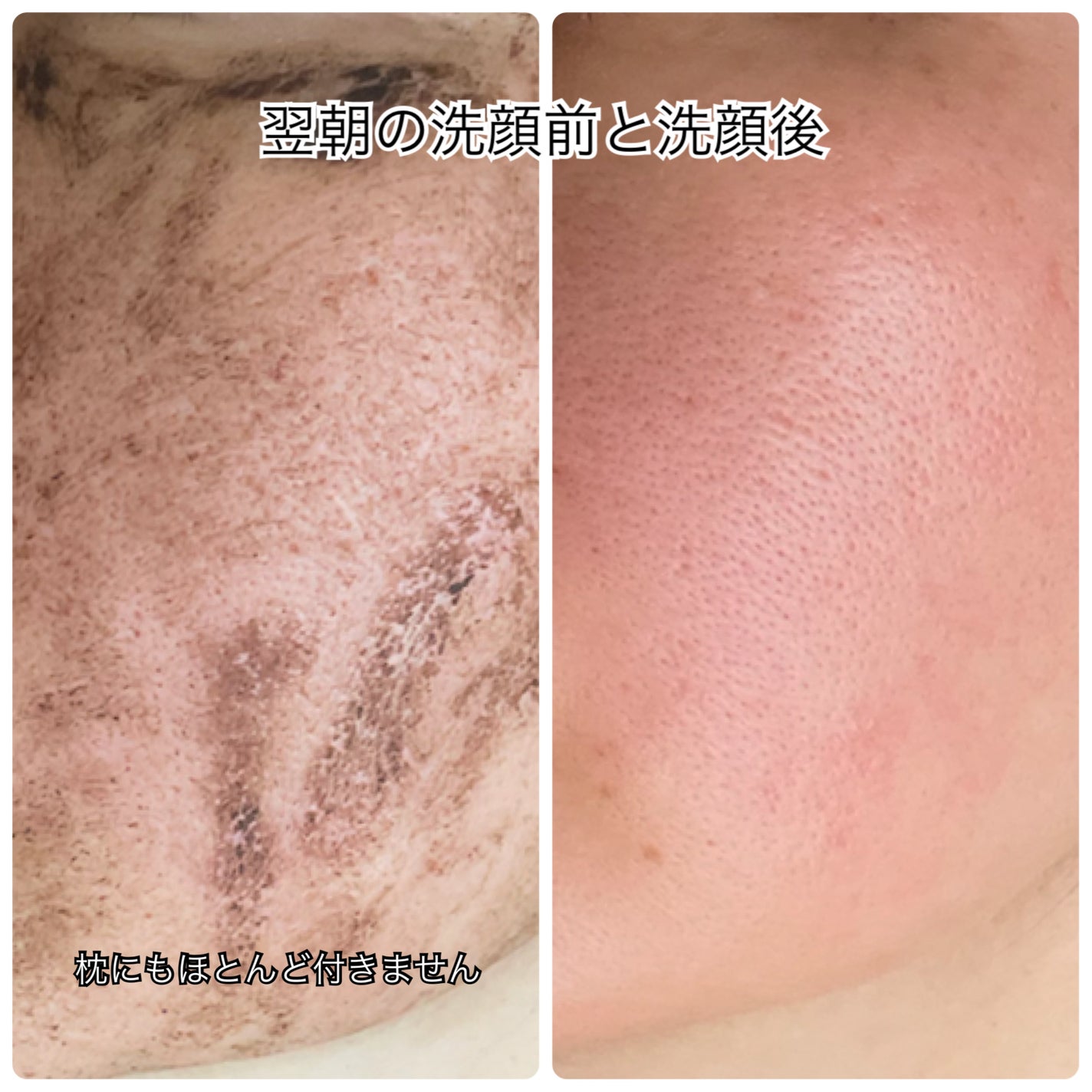 ダーマスキンピーリング/BQCELL/その他キットセットを使ったクチコミ(3枚目)