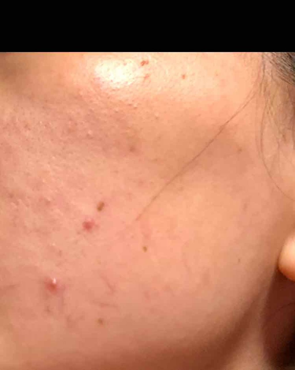 アクネケア おためしキット/ファンケル/トライアルキットを使ったクチコミ(3枚目)