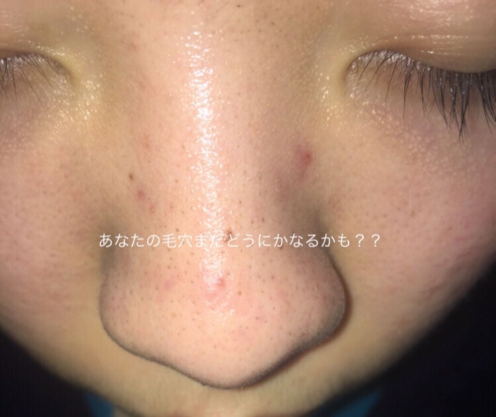 ひな➰ on LIPS 「あなたのブラックヘッドどうにかなるかもしれない?!#ホボバオイ..」(1枚目)