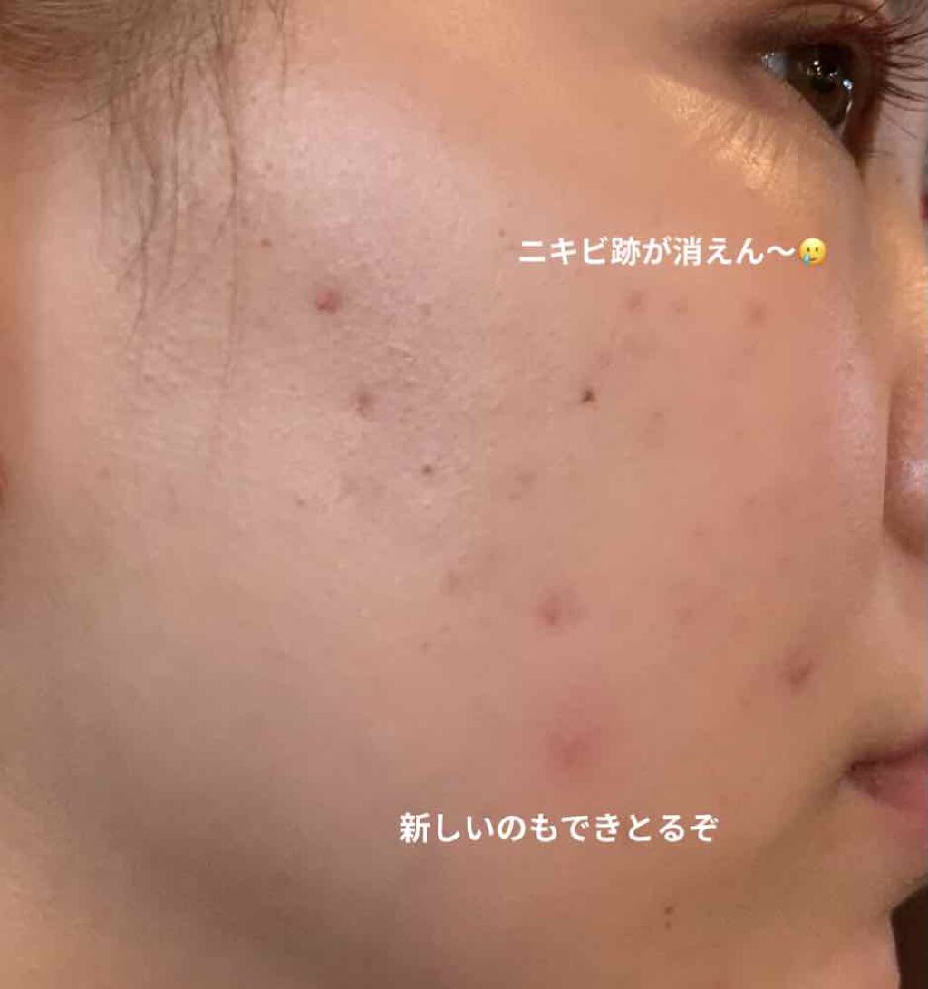 TOUT VERT クリスタルパウダーのクチコミ「生理前になるとやっぱりできるよね〜

あと、これでニキビ跡が何日で消えた！

とかあるけど本当.....」（1枚目）