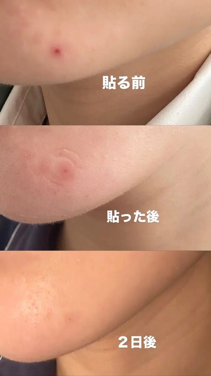 エイクリアスポットキュアパッチ/Dr.G/その他スキンケアを使ったクチコミ(5枚目)