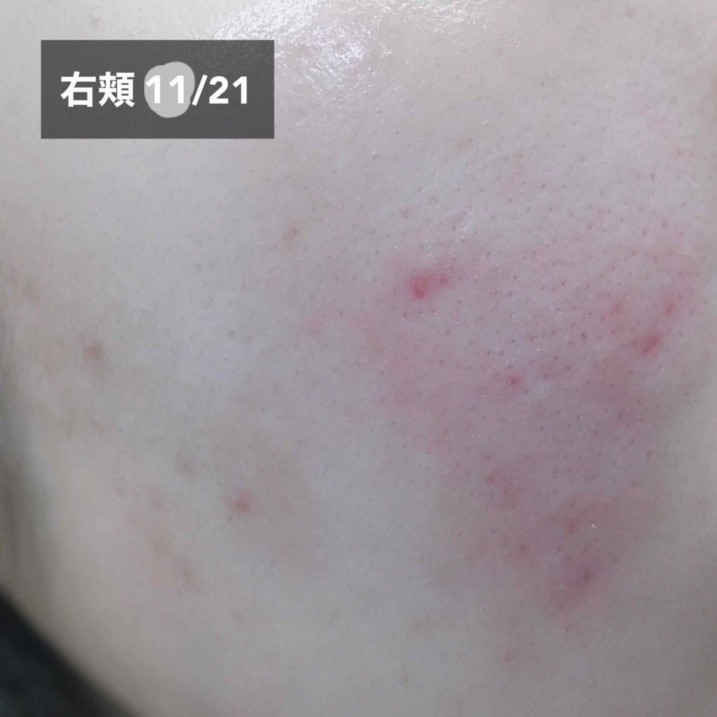 もち on LIPS 「ニキビ治療結果こんにちは、こんばんは!もちです☺️今回は、以前..」(2枚目)