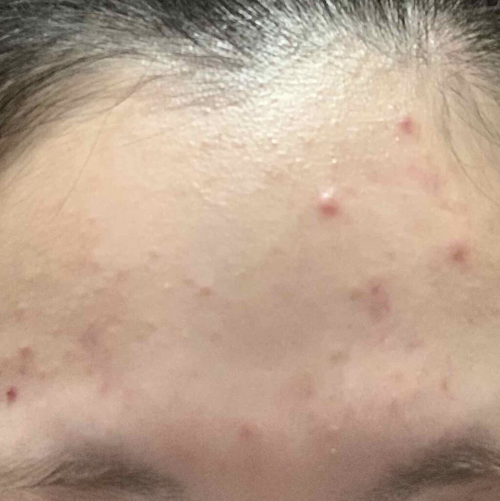 ミノン アミノモイスト 薬用アクネケア ローション/ミノン/化粧水を使ったクチコミ（2枚目）