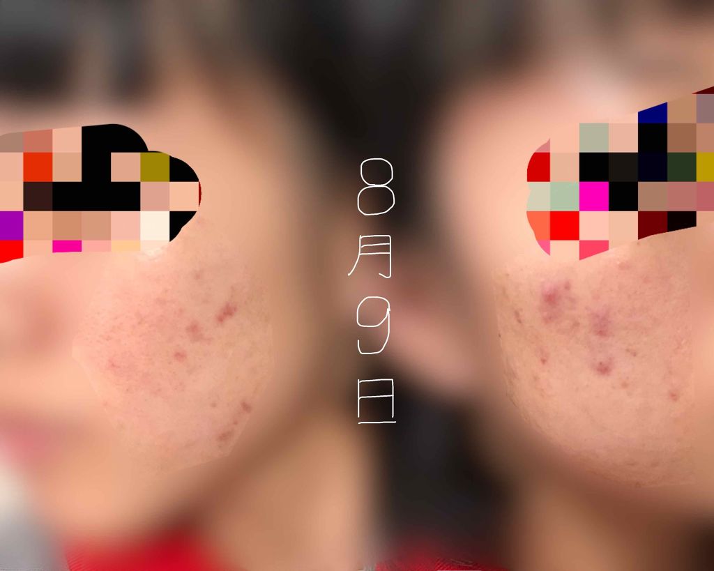 薬用 しみ 集中対策 美容液/メラノCC/美容液を使ったクチコミ（3枚目）