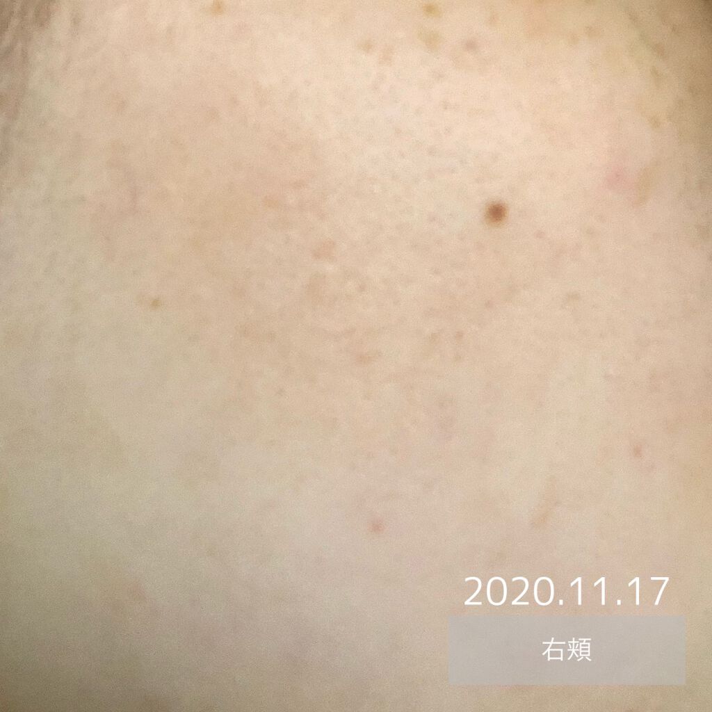 オードムーゲ 薬用ローション(ふきとり化粧水)/オードムーゲ/拭き取り化粧水を使ったクチコミ(5枚目)