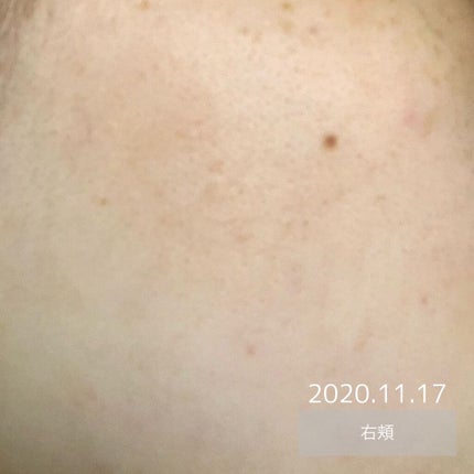 オードムーゲ 薬用ローション(ふきとり化粧水)/オードムーゲ/拭き取り化粧水を使ったクチコミ(5枚目)